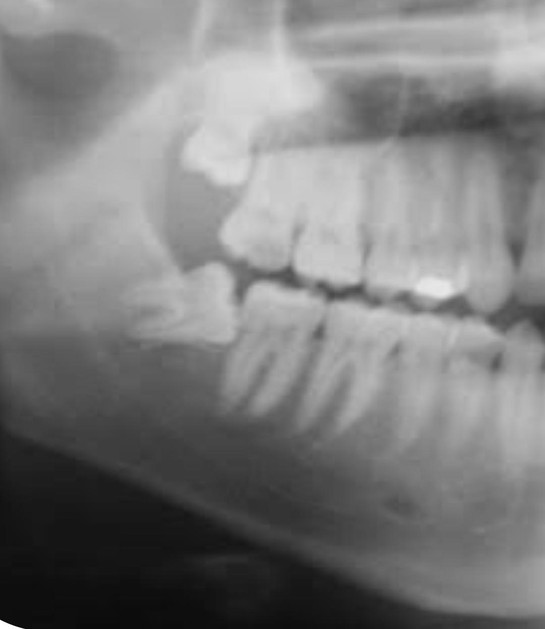 Radiografía dental